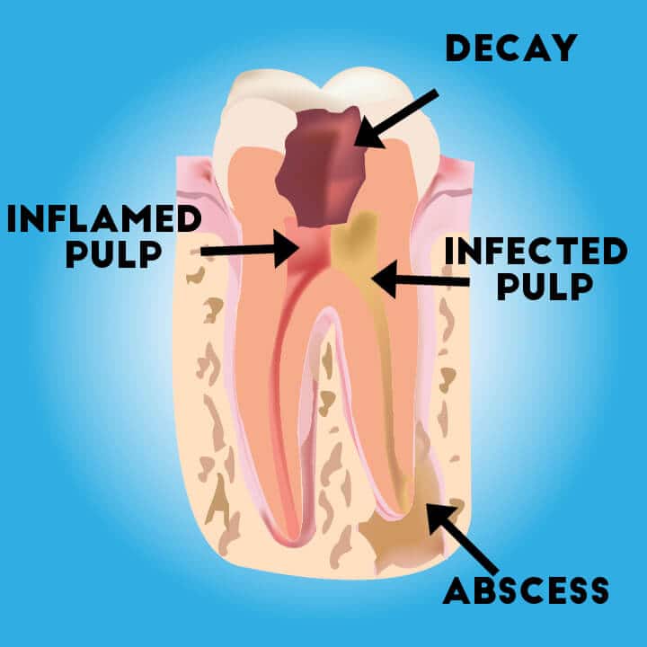 Illustration of tooth decay, abscess, inflamed and infected pulp