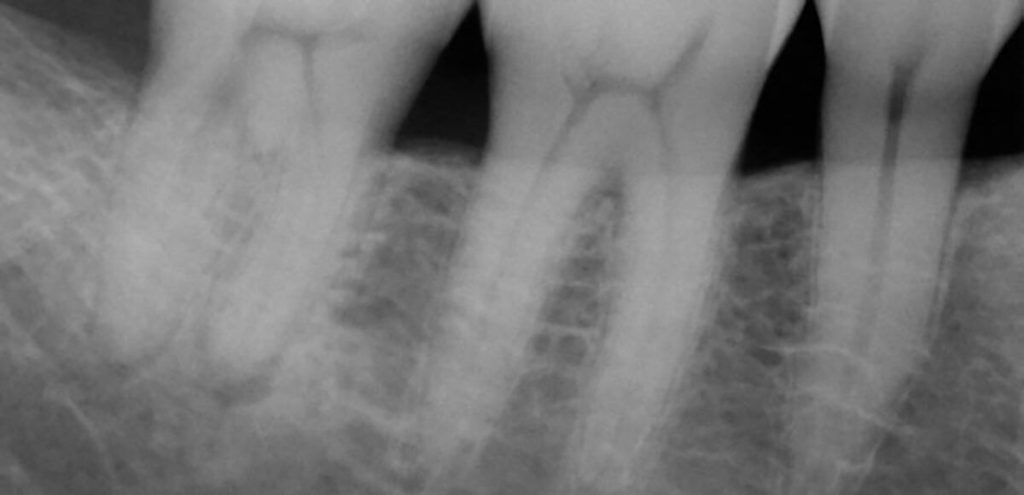 an x-ray of the roots of several teeth